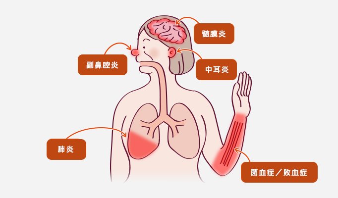 髄膜炎は脳 副鼻腔炎は鼻 中耳炎は耳 菌血縁/敗血症は血管 肺炎は肺