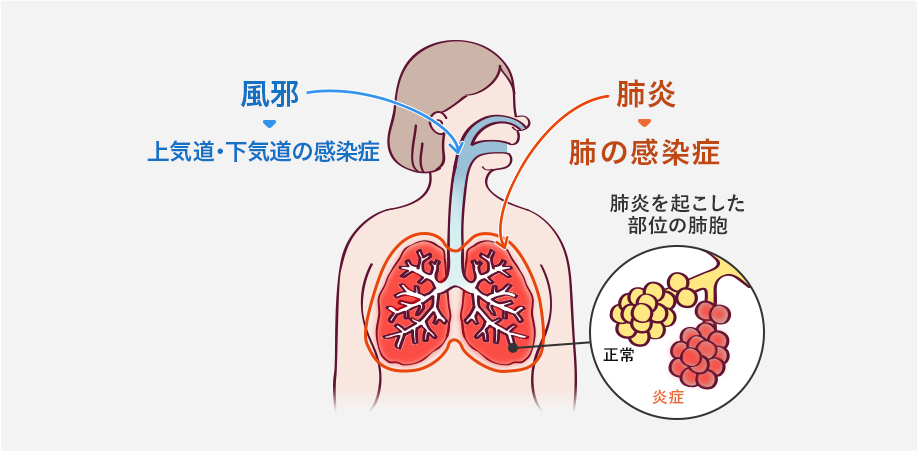 風邪は上気道・下気道の感染症 肺炎は肺の感染症