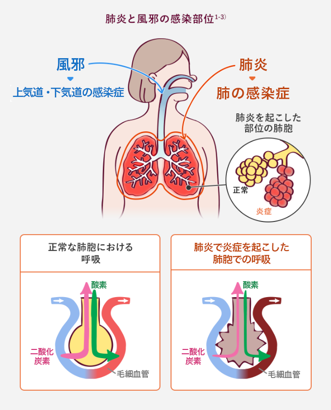 肺炎と風邪の感染部位 風邪は上気道・下気道の感染症 肺炎は肺の感染症