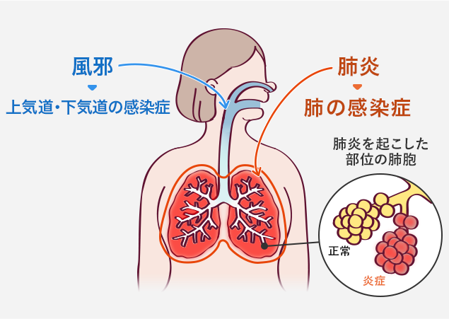 風邪は上気道・下気道の感染症 肺炎は肺の感染症