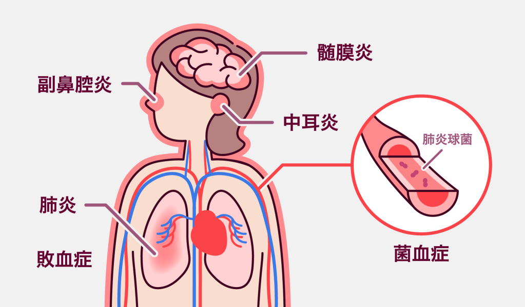 髄膜炎は脳 副鼻腔炎は鼻 中耳炎は耳 菌血縁/敗血症は血管 肺炎は肺