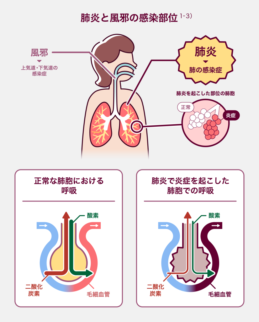 肺炎と風邪の感染部位 風邪は上気道・下気道の感染症 肺炎は肺の感染症
